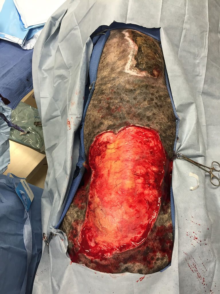 Skin removed from burned area